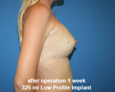 plastic-surgery-breast-augmentation